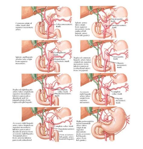 Variations in Celiac Trunk Anatomy Common origin of celiac trunk and superior mesenteric artery ...