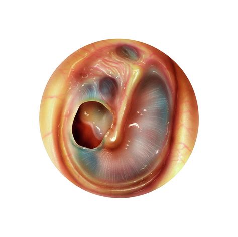 Perforated Eardrum Photograph by Bo Veisland/science Photo Library - Pixels