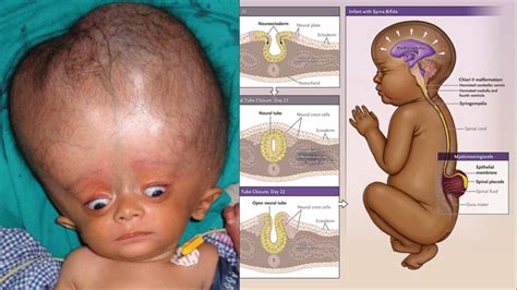 Understanding Spina bifida and hydrocephalus - Bethany TV