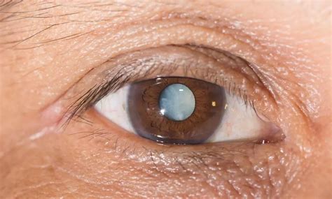 Anopsia - Signs, Treatment, Causes, Forms, Diagnosis | Diseases 2024