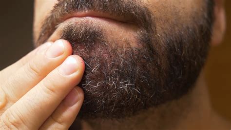 How to Take Care of Seborrheic Dermatitis Under Beards | National ...