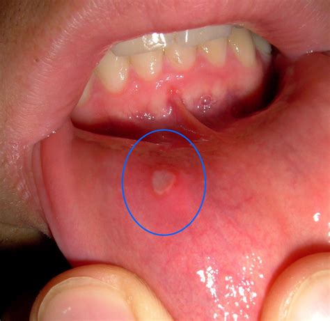 Mouth ulcer - Wikipedia