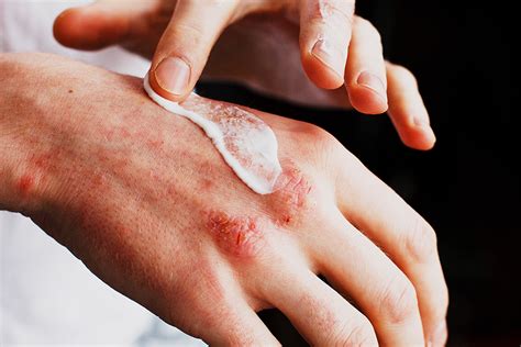 9 tips to prevent and treat eczema | Brunet