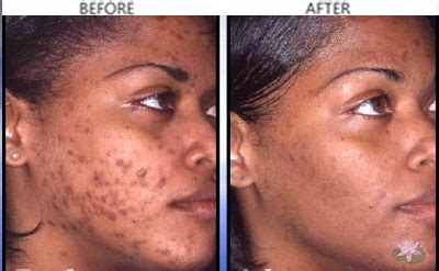 Vitamin e acne scars before and after