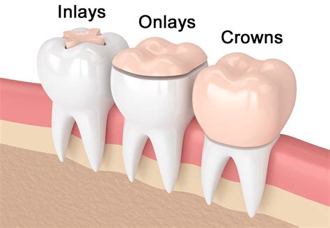 Inlays and Onlays | Private Dentist London | Dental Treatment Victoria