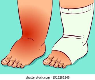 Swollen Feet Beforeafter Foot Protective Sock Stock Vector (Royalty Free) 1515285248 | Shutterstock
