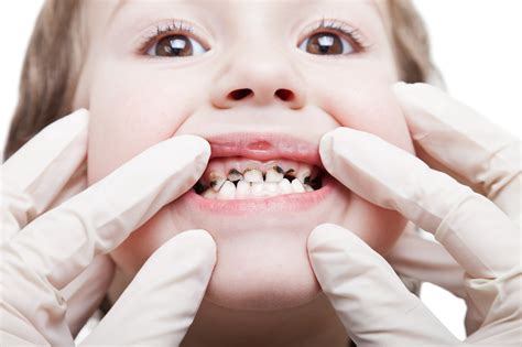 Children With Rotten Teeth