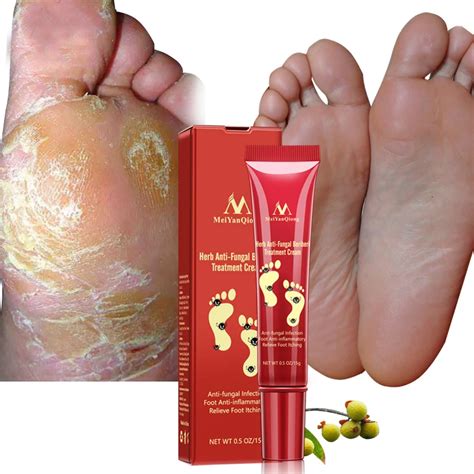 Herbal Foot Treatment Anti Fungal Infection Onychomycosis Paronychia Effective Toe Fungus ...