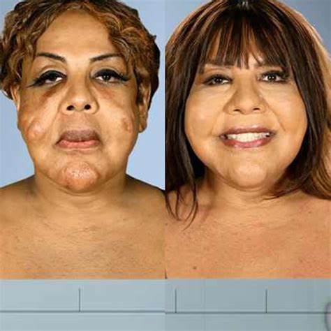 Botched Patients Before and After: Shocking Transformations! - TrendRadars