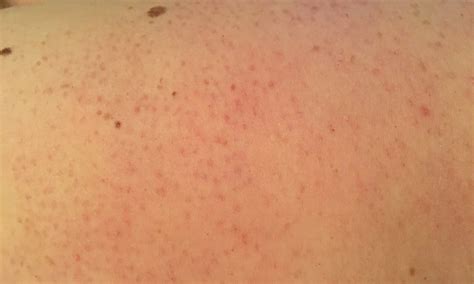 Red Dots On Skin Pictures Causes Treatment And When T - vrogue.co
