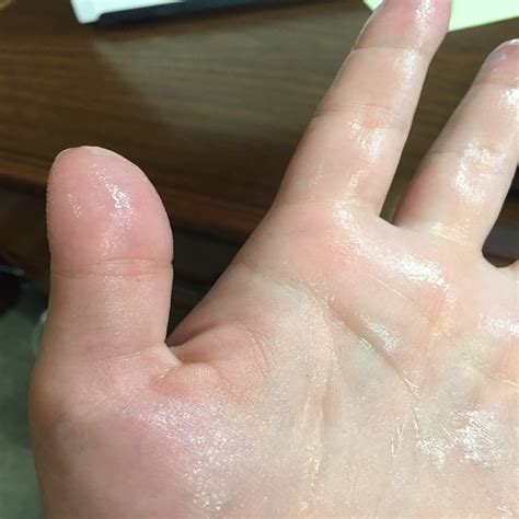 Guest Post: Hyperhidrosis in Arkansas - My Life as a Puddle