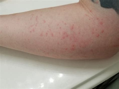 Hiv Rash Arms