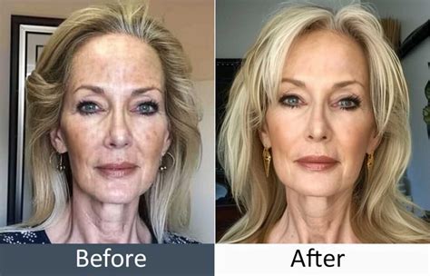 Lose Weight, Gain Wrinkles? The "Ozempic Face" Fix