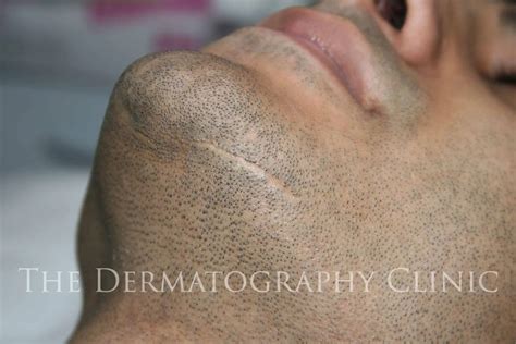 Beard Tattoo For Men - The Dermatography Clinic