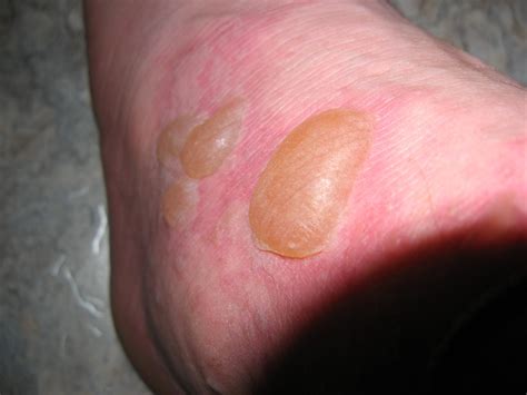 Blisters from Allergic reaction | Dhugal Fletcher | Flickr