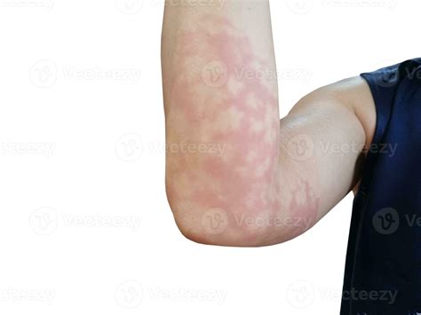 red rash on arm allergic reaction white background 24604672 Stock Photo ...