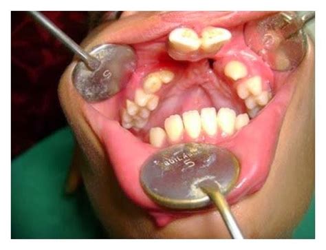 Van der Woude syndrome with cleft lip and palate | Download Scientific Diagram