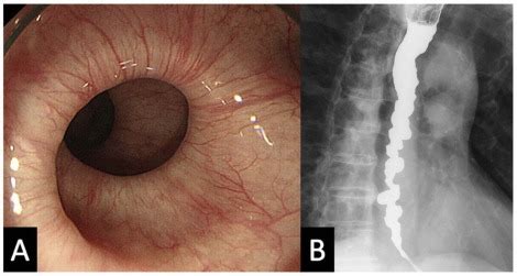 Diffuse Esophageal Spasm: Corkscrew Esophagus - The American Journal of ...