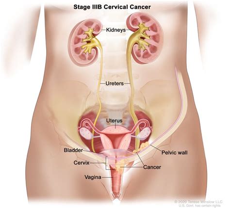 hard pea sized lump on cervix - Pregnancy Depression