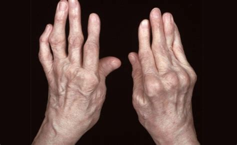 Hand Arthritis: Symptom, Treatment and Exercise | New Health Advisor