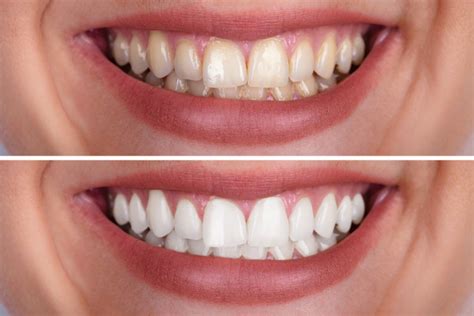 Can Teeth Whitening Damage Tooth Enamel?