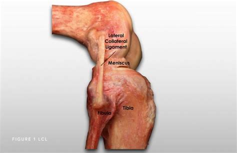 LCL Tear Chicago, IL | Dr. Jorge Chahla