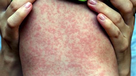 22 Common Skin Rashes: Pictures, Causes, and Treatment