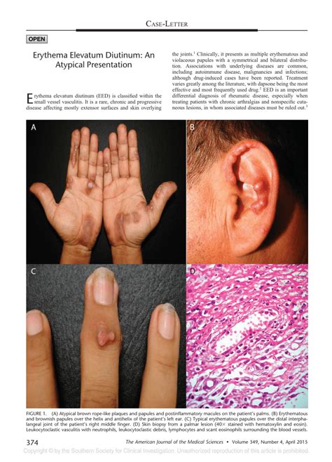 (PDF) Erythema Elevatum Diutinum: An Atypical Presentation