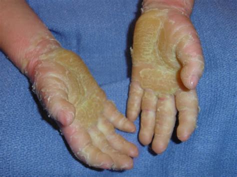 Hyperkeratosis definition, causes, prognosis & hyperkeratosis treatment