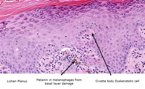 Dermatopathology Made Simple - Inflammatory: Lichenoid / Vacuolar ...