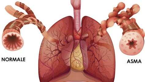 Bronchial asthma: symptoms and treatment | Emergency Live