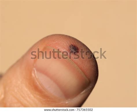 Blood Blister On Finger Injuried Accidental Stock Photo 757365502 | Shutterstock