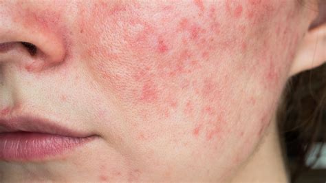 What Is Rosacea? Causes, Symptoms, Treatment, and Prevention - GoodRx