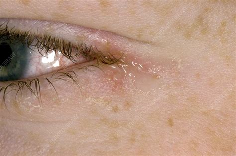 Eye Herpes - Herpes Symptoms, Causes, Types, Treatments - Post Oak ER