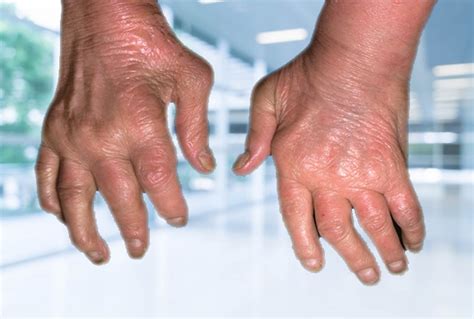 Pustular Psoriatic Arthritis