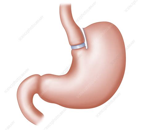 Vertical Banded Gastroplasty - Stock Image - C020/9497 - Science Photo Library