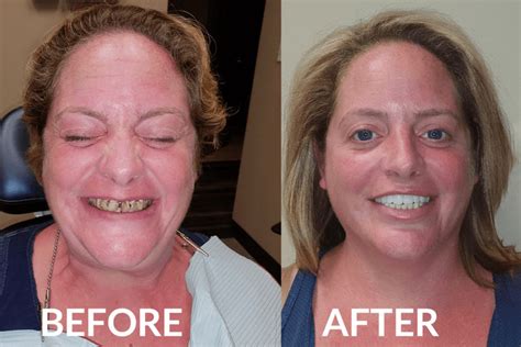 Full Mouth Reconstruction | Houston, TX | Amazing Dental Solutions