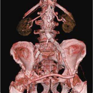 a). 3-D digital computed aortography 3 months following the procedure ...