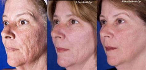 TRL™ Facial Laser Resurfacing — Lake Oswego Aesthetics, LLC