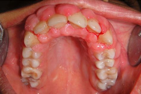 Phenytoin Gingival Hyperplasia