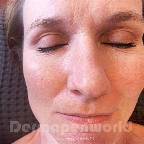 Enlarged Pores Treatment - Microneedling for Large Pores | DermapenWorld