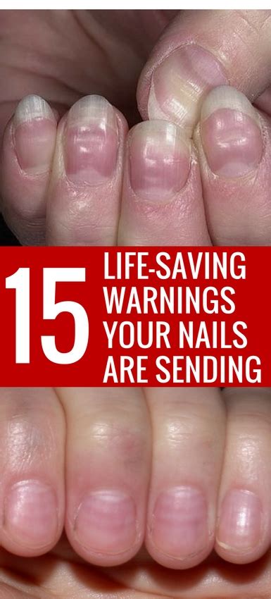 15 Health WARNINGS Your Fingernails May Be Sending