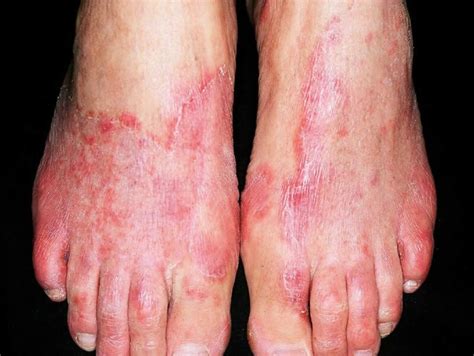 Tinea pedis, athlete's foot, causes, symptoms, diagnosis & treatment