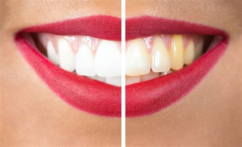 What Causes Dental Discoloration? - Longview, TX Dentistry