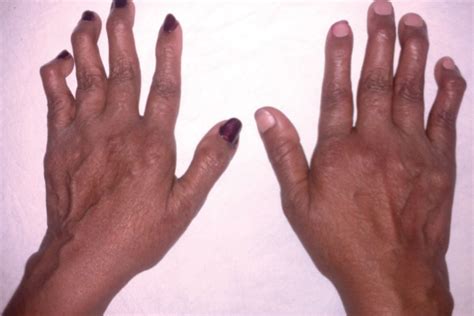 Rheumatoid Arthritis Thumb