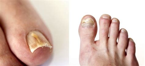 What Causes Toe Fungus