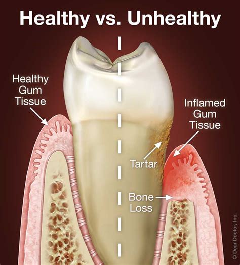 Periodontal Gum Disease | Coastal Periodontics & Implant Dentistry ...