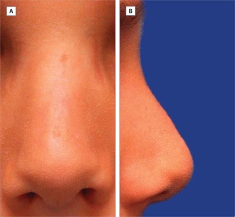 Midline Approach to Pediatric Nasofrontal Dermoid Cysts | Dermatology ...