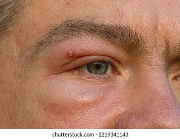 Man Swollen Eye Bee Sting Swelling Stock Photo 2219341143 | Shutterstock