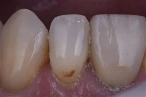 Incipient caries removal and invisible restoration